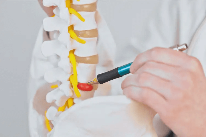 microdisectomy